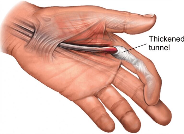 Springfinger Symptoms Causes And Effective Treatment springfinger-symptoms-causes-and-effective-treatment